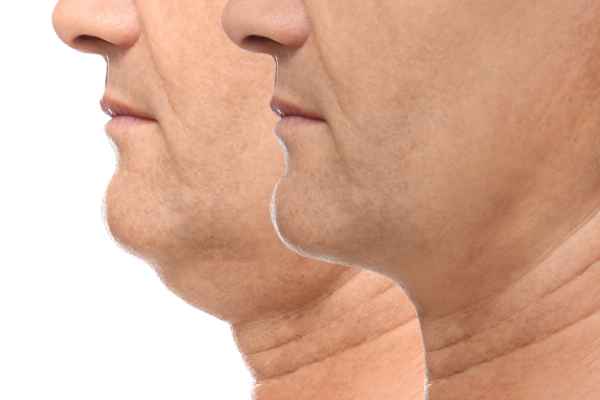 HIFU - Breakthrough in Anti - ageing 2 hifu results Southall