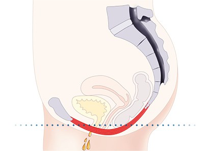 Pelvic-Floor Muscle Repair 5 Pelvic floor muscles Southall