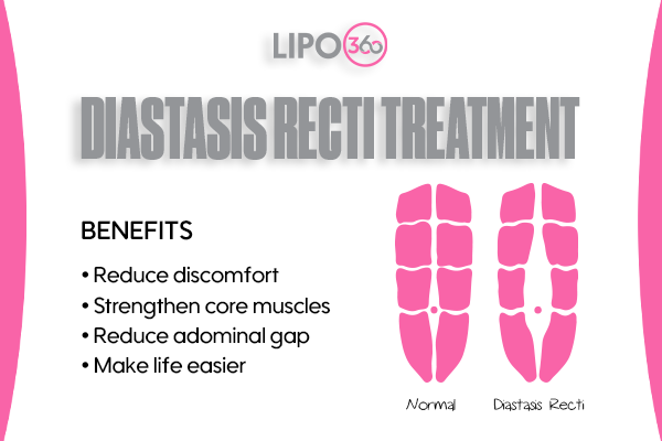 Revolutionising Muscle Repair: The Power of LIPO360 Body Sculpt Post-Injury 5 diastasis recti treatment Southall