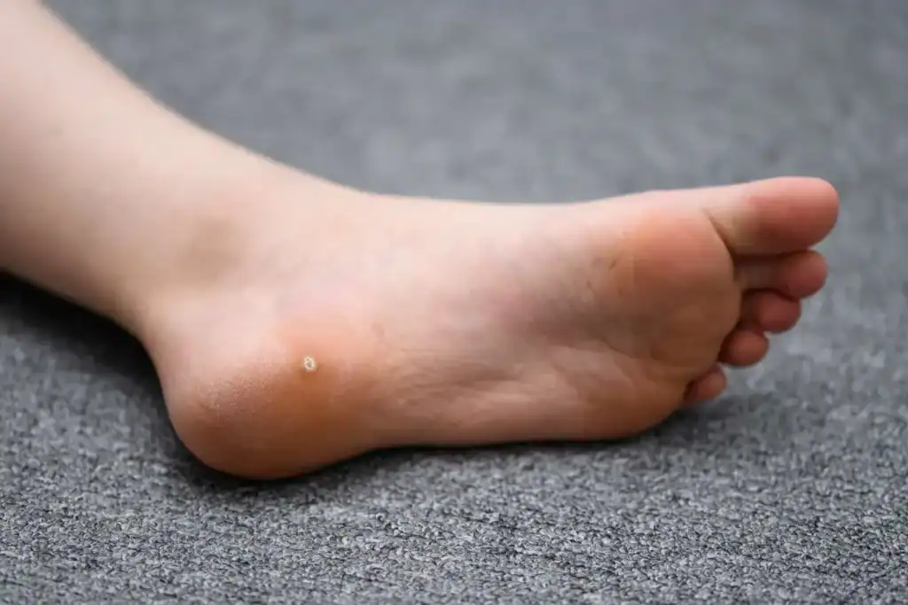Cryotherapy For Warts And Also Verrucas 2 Image of verruca on the bottom of the foot that able to be treated with Cryotherapy Southall