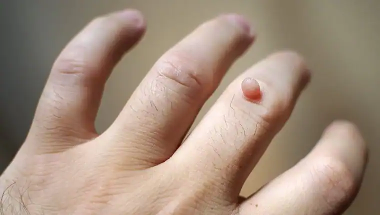 Cryotherapy For Warts And Also Verrucas 1 Image of blemish that Cryotherapy Southall can remove with Lipo 360.