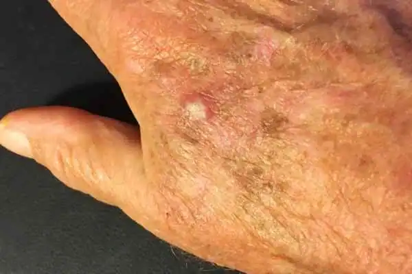 Cryopen For Actinic Keratoses 1 Image of Actinic keratoses Southall on a person hand
