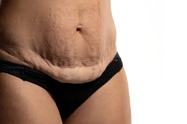 The Science of Skin Tightening 1 The science behind skin tightening Southall picture of a woman's sagging skin on the stomach